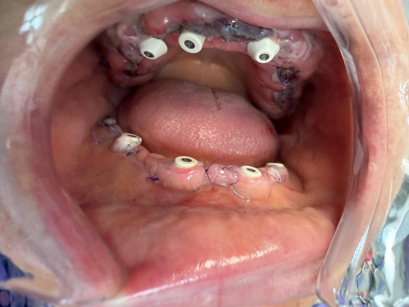 Implanturi dentare cu bonturi multi-unit montate, înainte de fixarea lucrării provizorii