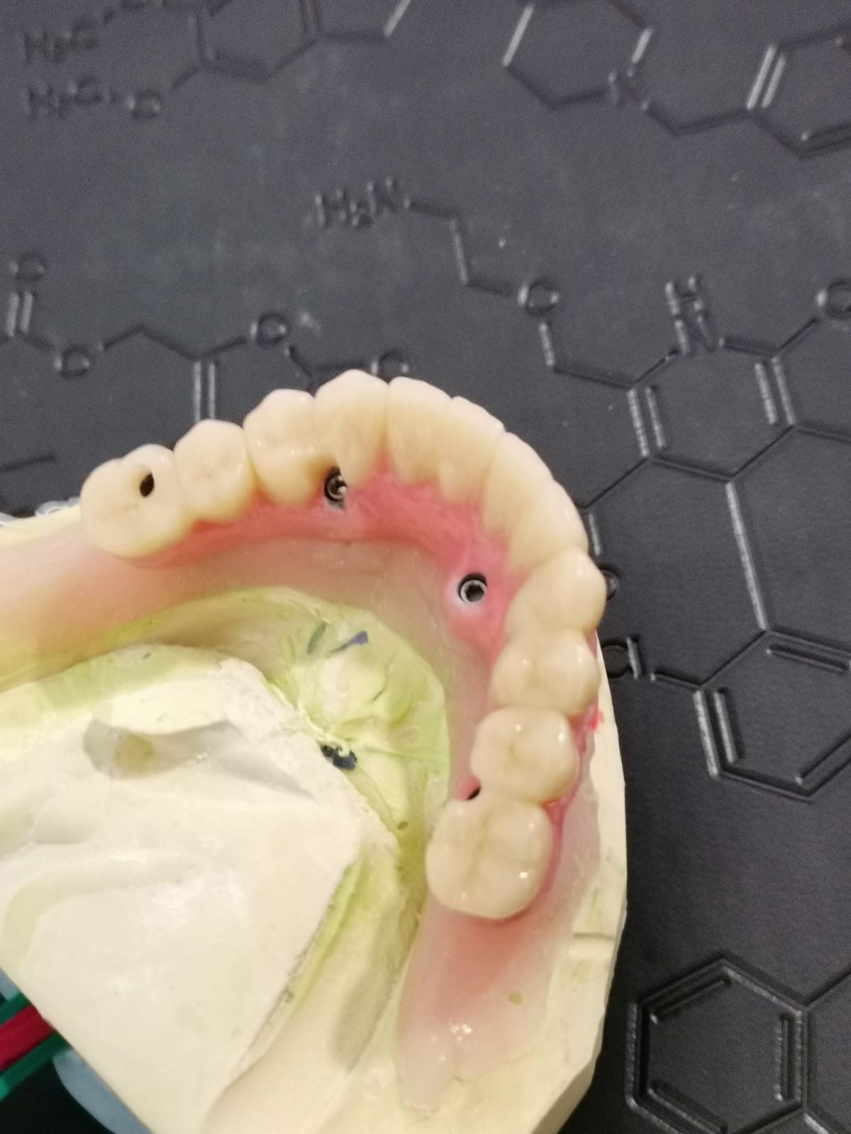 Lucrare dentară fixă pe implanturi pe modelul de laborator, cu canalele de acces pentru șuruburi