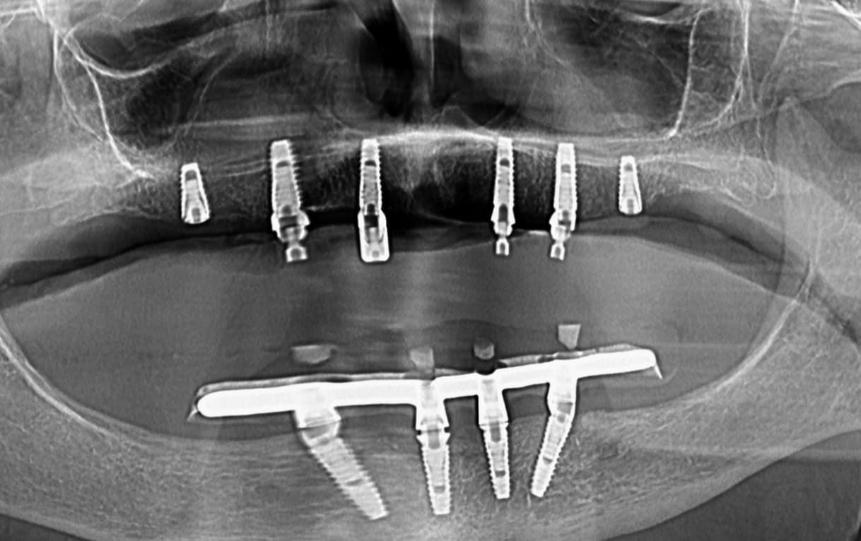 Radiografie panoramică cu implanturi dentare inserate pe ambele arcade, pregătite pentru dinți ficși